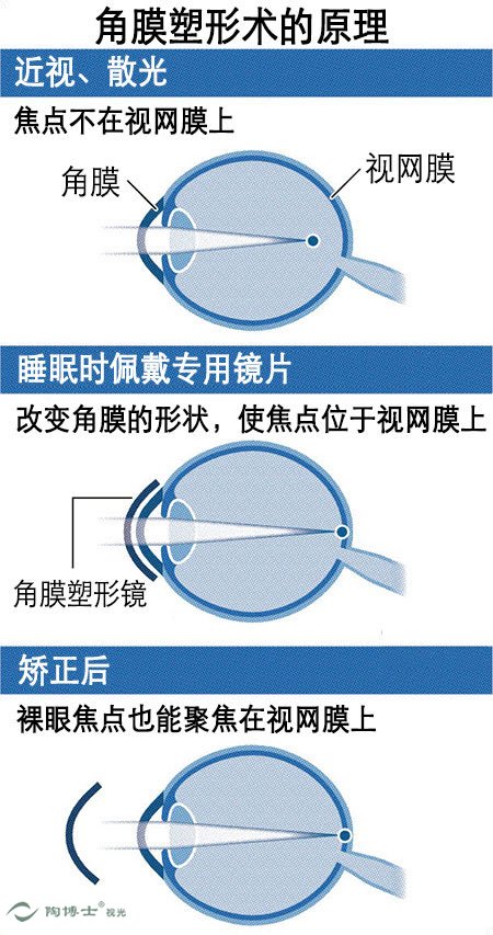角膜塑形术原理